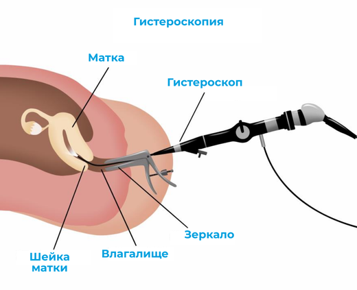 Как проходит гистероскопия