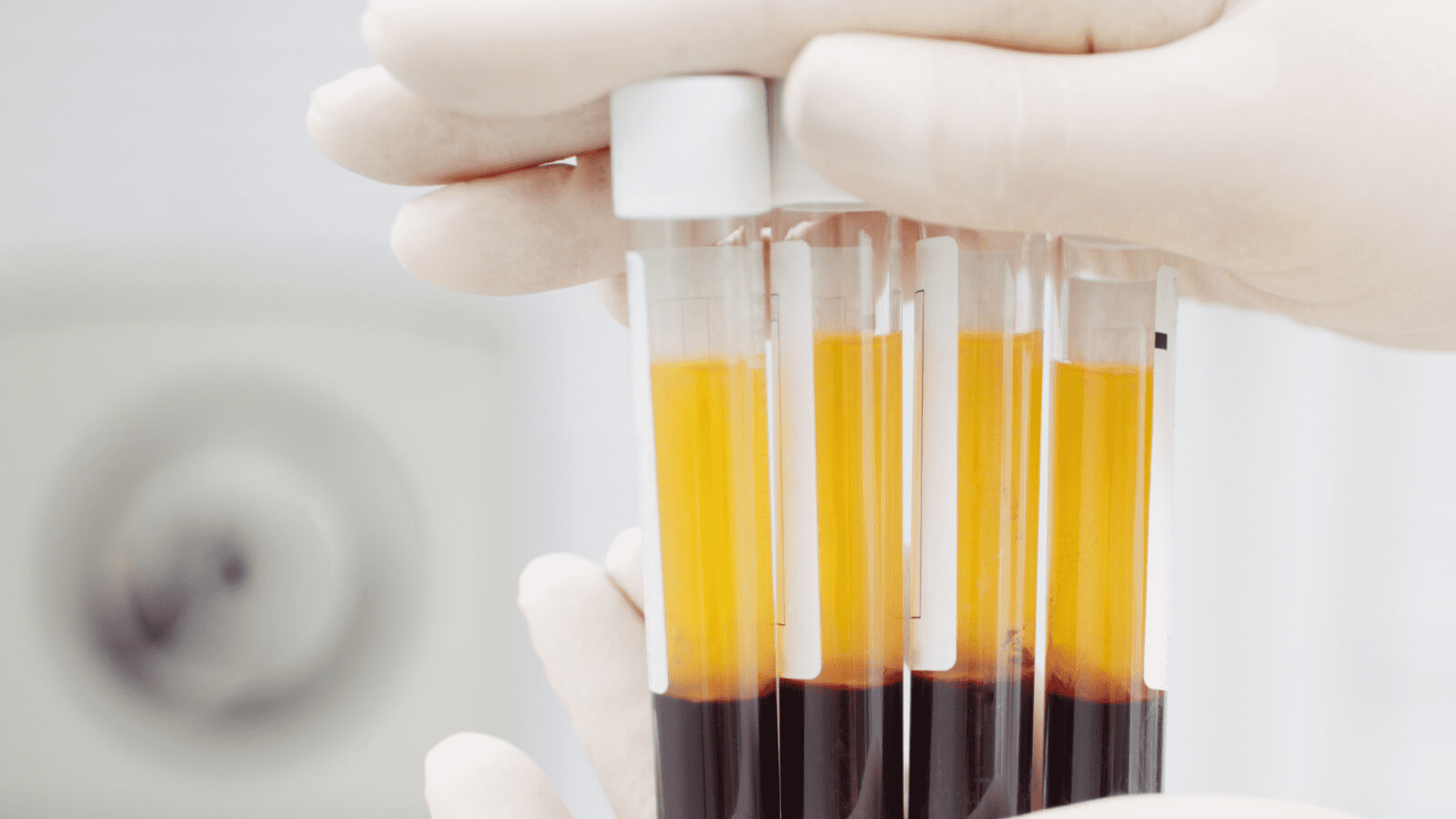 Плазмолифтинг. Процедура для красоты и здоровья в МЦ Норма